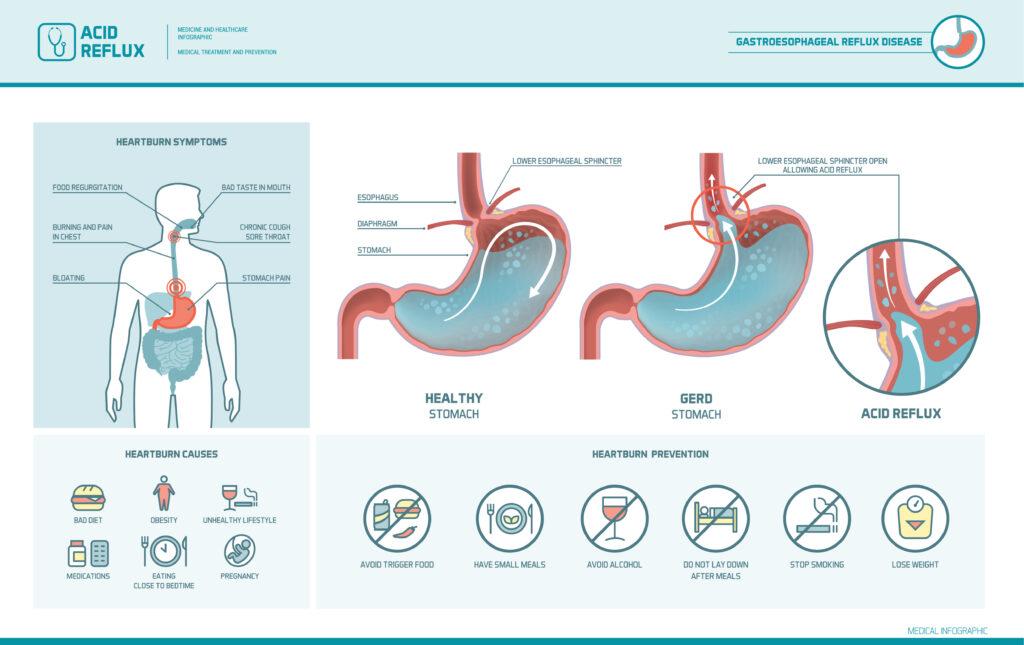 What Side To Lay On To Ease Heartburn At Laverne Crawford Blog