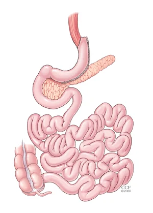 gastric sleeve.