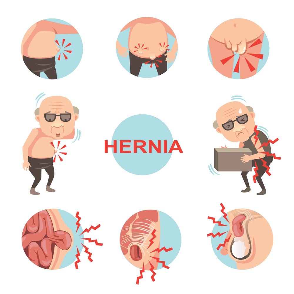 Hernia treatment.