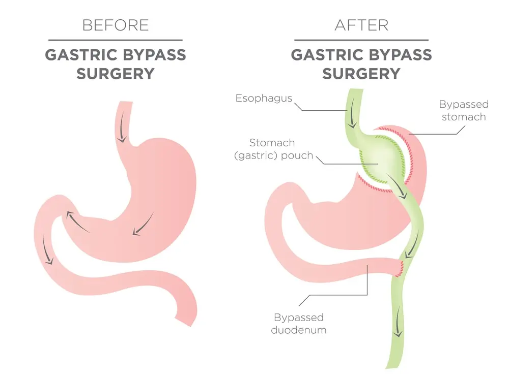 gastric bypass.