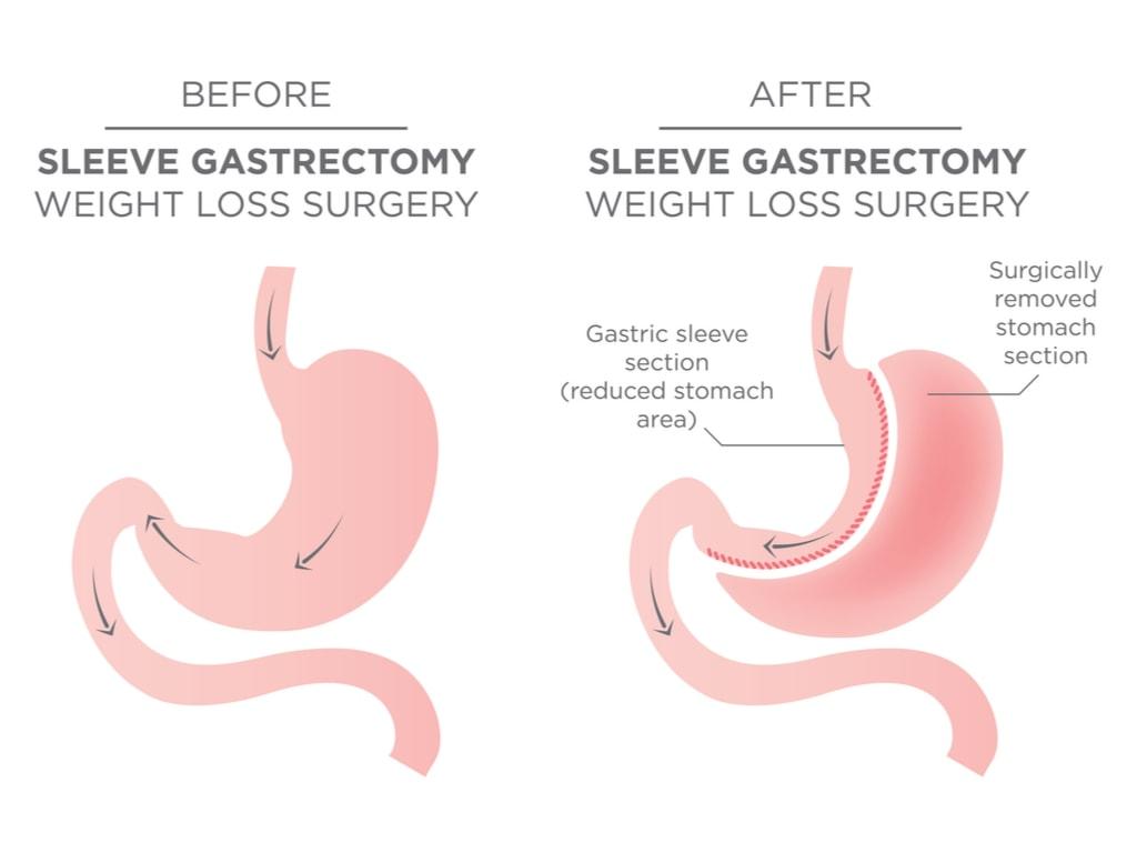 Gastric Sleeve Surgery In Phoenix Dignity Health Medical Group