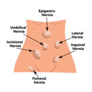 graphic showing the locations of the types of hernia