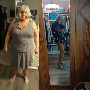 female before and after weight loss surgery 3.